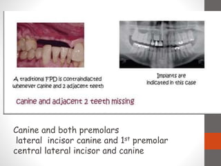 Canine and both premolars
lateral incisor canine and 1st premolar
central lateral incisor and canine
 
