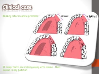 Missing lateral canine premolar
If many teeth are missing along with canine , then
Canine is key position
 