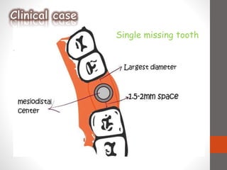 Single missing tooth
 