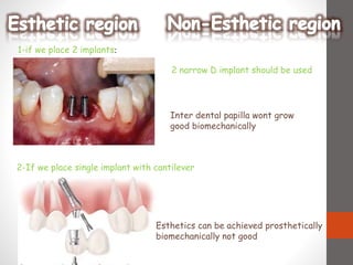 1-if we place 2 implants:
2-If we place single implant with cantilever
Esthetics can be achieved prosthetically
biomechanically not good
2 narrow D implant should be used
Inter dental papilla wont grow
good biomechanically
 