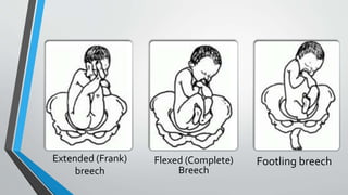 Extended (Frank)
breech
Footling breech
Flexed (Complete)
Breech
 