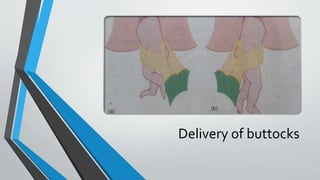 Delivery of buttocks
 