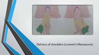 Delivery of shoulders (Loveset's Manoeuvre)
 