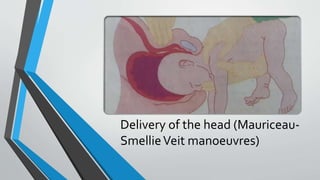 Delivery of the head (Mauriceau-
SmellieVeit manoeuvres)
 