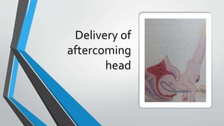 Delivery of
aftercoming
head
 