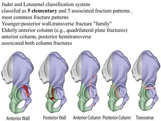 ACETABULAR FRACTURE AND MANAGEMENT | PPTX