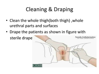 Cleaning & Draping
• Clean the whole thigh(both thigh) ,whole
urethral parts and surfaces
• Drape the patients as shown in figure with
sterile drape
 