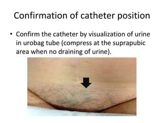 Confirmation of catheter position
• Confirm the catheter by visualization of urine
in urobag tube (compress at the suprapubic
area when no draining of urine).
 