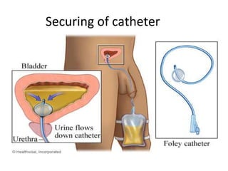 Securing of catheter
 