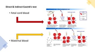 Direct & Indirect Coomb’s test
• Fetal cord blood
• Maternal blood
 