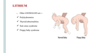 ● Other ANOMALIES are --
 Polyhydromnios
 Thyroid abnormalities
 Sick sinus syndrome
 Floppy baby syndrome
LITHIUM
 