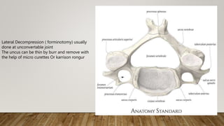 Anterior Cervical Corpectomy | PPTX
