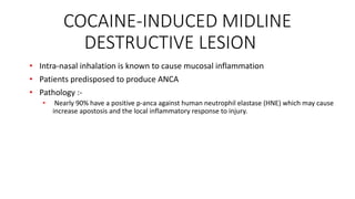 COCAINE-INDUCED MIDLINE
DESTRUCTIVE LESION
• Intra-nasal inhalation is known to cause mucosal inflammation
• Patients predisposed to produce ANCA
• Pathology :-
• Nearly 90% have a positive p-anca against human neutrophil elastase (HNE) which may cause
increase apostosis and the local inflammatory response to injury.
 