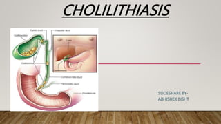 CHOLILITHIASIS
SLIDESHARE BY-
ABHISHEK BISHT
 