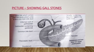 PICTURE – SHOWING GALL STONES
 