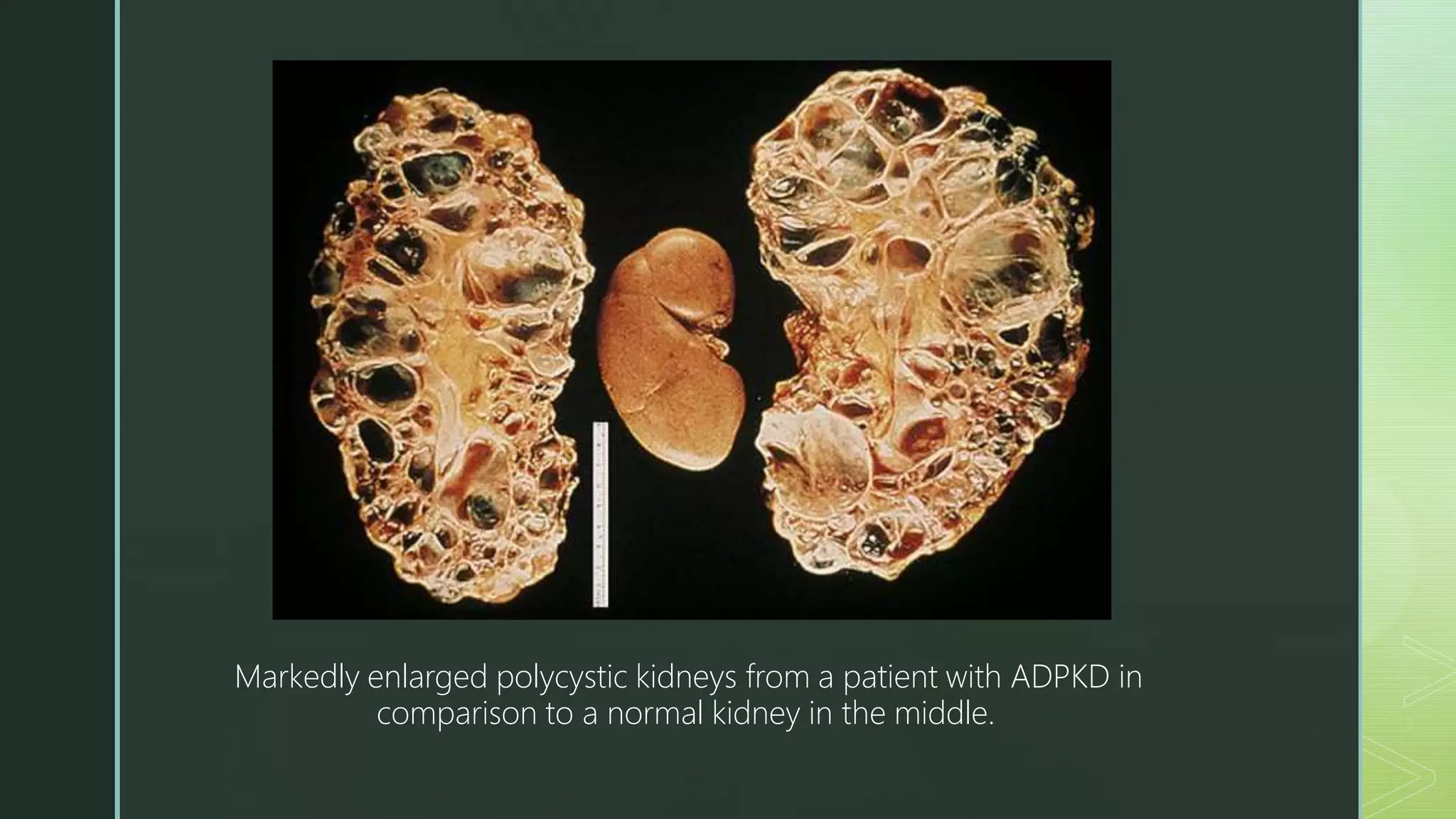 Markedly enlarged polycystic kidneys from a patient with ADPKD in
comparison to a normal kidney in the middle.
 