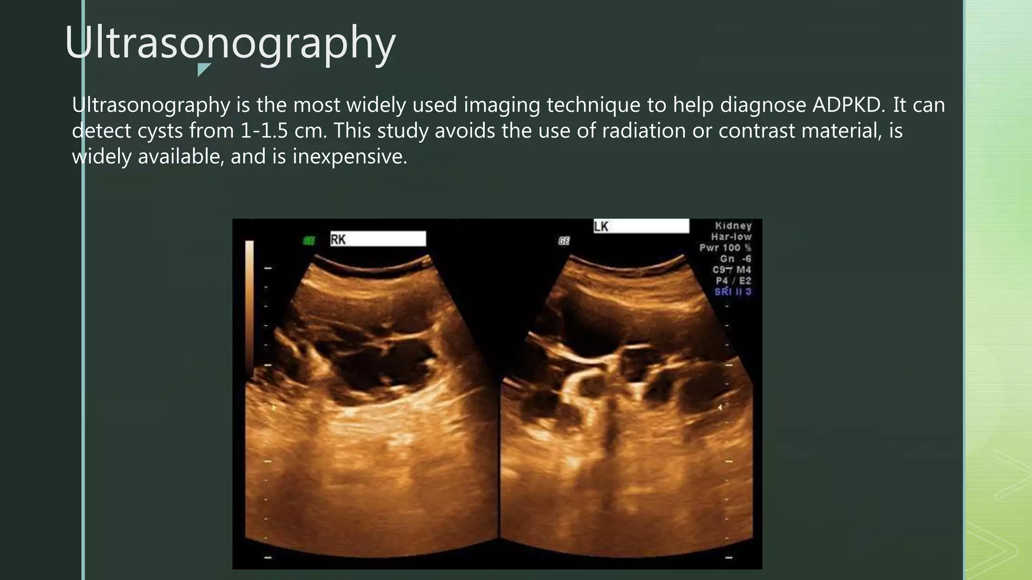z
Ultrasonography
Ultrasonography is the most widely used imaging technique to help diagnose ADPKD. It can
detect cysts from 1-1.5 cm. This study avoids the use of radiation or contrast material, is
widely available, and is inexpensive.
 