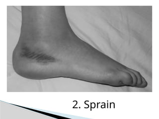 2. Sprain
 