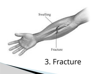 3. Fracture
 