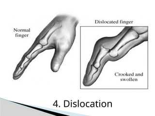 4. Dislocation
 
