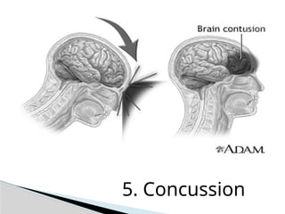 5. Concussion
 