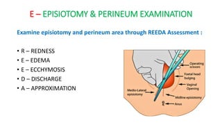 E – EPISIOTOMY & PERINEUM EXAMINATION
Examine episiotomy and perineum area through REEDA Assessment :
• R – REDNESS
• E – EDEMA
• E – ECCHYMOSIS
• D – DISCHARGE
• A – APPROXIMATION
 