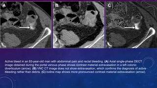 Dual Energy CT in evaluation of gastrointestinal bleed | PPTX