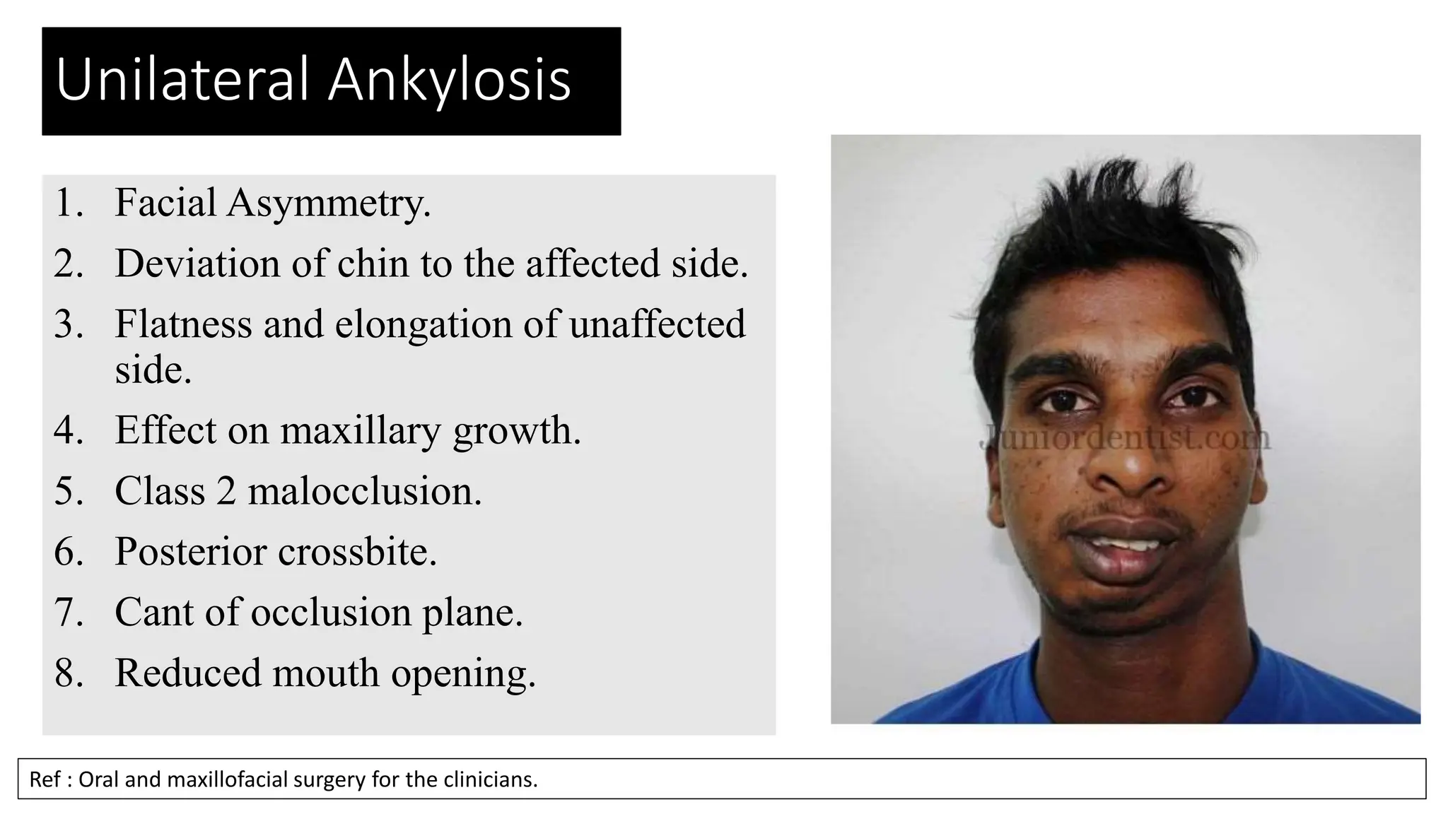 Unaffected Side TMJ ANKYLOSIS of the Jaw and its clinical significancies | PPTX