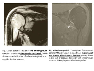 Axillary Pouch Radiology shoulder pathologies MRI: basic anatomy and MRI scans | PPTX