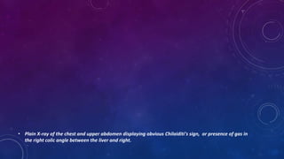 • Plain X-ray of the chest and upper abdomen displaying obvious Chilaiditi's sign, or presence of gas in
the right colic angle between the liver and right.
 