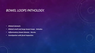 BOWEL LOOPS PATHOLOGY.
• Dilated stomach.
• Dilated small and large bowel loops. Volvulus.
• Inflammatory bowel disease. Hernia.
• Constipation with fecal impaction.
 