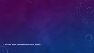 • CT scout image showing massive gastric dilation.
 