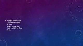 • Upright abdominal X-
ray demonstrating
a small
bowel obstruction.
Note multiple air fluid
levels.
 