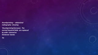 • thumbprinting – abdominal
radiography showing
• ‘thumbprinting’(arrows). The
normal haustral folds are replaced
by wide transverse
thickened bands.
• Ttt
 