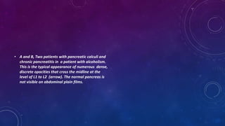 • A and B, Two patients with pancreatic calculi and
chronic pancreatitis in a patient with alcoholism.
This is the typical appearance of numerous dense,
discrete opacities that cross the midline at the
level of L1 to L2 (arrow). The normal pancreas is
not visible on abdominal plain films.
 