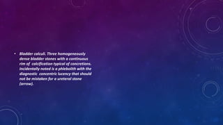 • Bladder calculi. Three homogeneously
dense bladder stones with a continuous
rim of calcification typical of concretions.
Incidentally noted is a phlebolith with the
diagnostic concentric lucency that should
not be mistaken for a ureteral stone
(arrow).
 