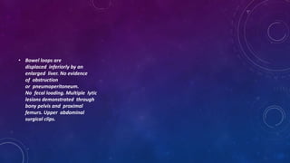 • Bowel loops are
displaced inferiorly by an
enlarged liver. No evidence
of obstruction
or pneumoperitoneum.
No fecal loading. Multiple lytic
lesions demonstrated through
bony pelvis and proximal
femurs. Upper abdominal
surgical clips.
 