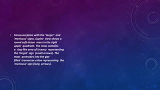 • Intussusception with the 'target' and
'meniscus' signs. Supine view shows a
round soft-tissue mass in the right
upper quadrant. The mass contains
a ring-like area of lucency representing
the 'target' sign (small arrows). The
mass protrudes into the gas-
filled transverse colon representing the
'meniscus' sign (long arrows).
 