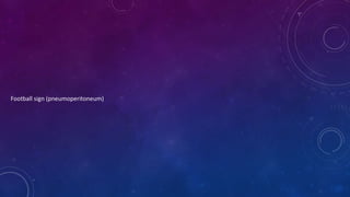 Football sign (pneumoperitoneum)
 