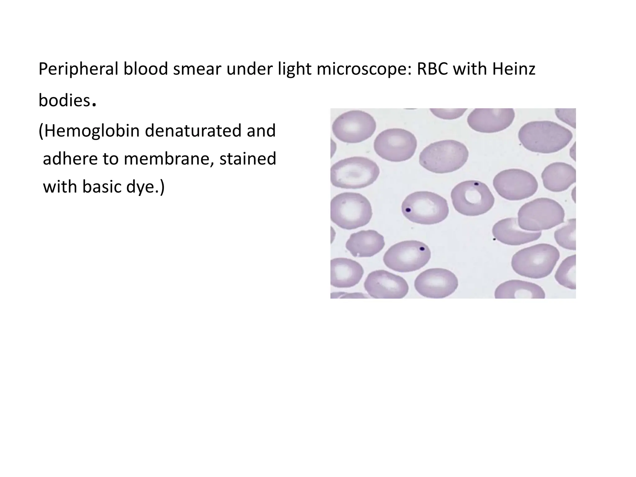 G6pd Deficiency Rbc Inclusions G6PD case and discussion on biochemical pathways.pptx