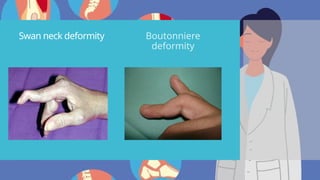 Swan neck deformity Boutonniere
deformity
 