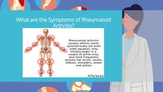 What are the Symptoms of Rheumatoid
Arthritis?
 