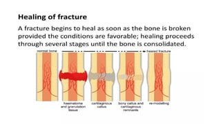 Principles of fracture management power point presentation | PPTX