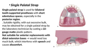 Posterier Strap Rpd Maxillary major connector (removable partial denture ) | PPTX