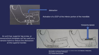 compression osteosynthesis in oral and maxillofacial surgery.pptx