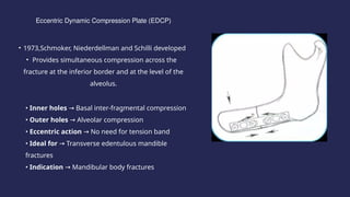 compression osteosynthesis in oral and maxillofacial surgery.pptx