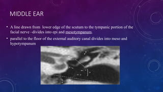 Scutum In Ear TEMPORAL BONE RADIOLOGY APPROACH HRCT .pptx