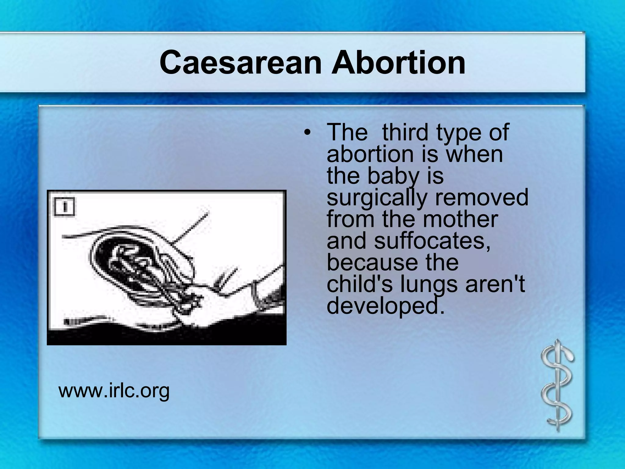 Caesarean Abortion The  third type of abortion is when the baby is surgically removed from the mother and suffocates, because the child's lungs aren't developed. www.irlc.org 