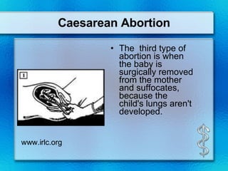 Caesarean Abortion The  third type of abortion is when the baby is surgically removed from the mother and suffocates, because the child's lungs aren't developed. www.irlc.org 