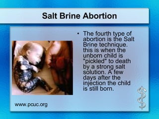 Salt Brine Abortion The fourth type of abortion is the Salt Brine technique. this is when the unborn child is "pickled" to death by a strong salt solution. A few days after the injection the child is still born. www.pcuc.org 